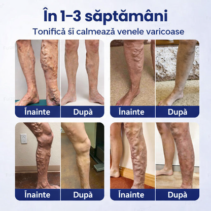Spray Pentru Varice – Confort Și Îngrijire Pentru Picioarele Tale