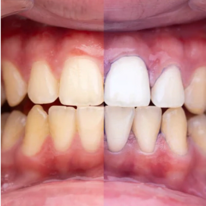 GlumiWhite – V34 Albire – [OFERTĂ VALABILĂ DOAR ASTĂZI]